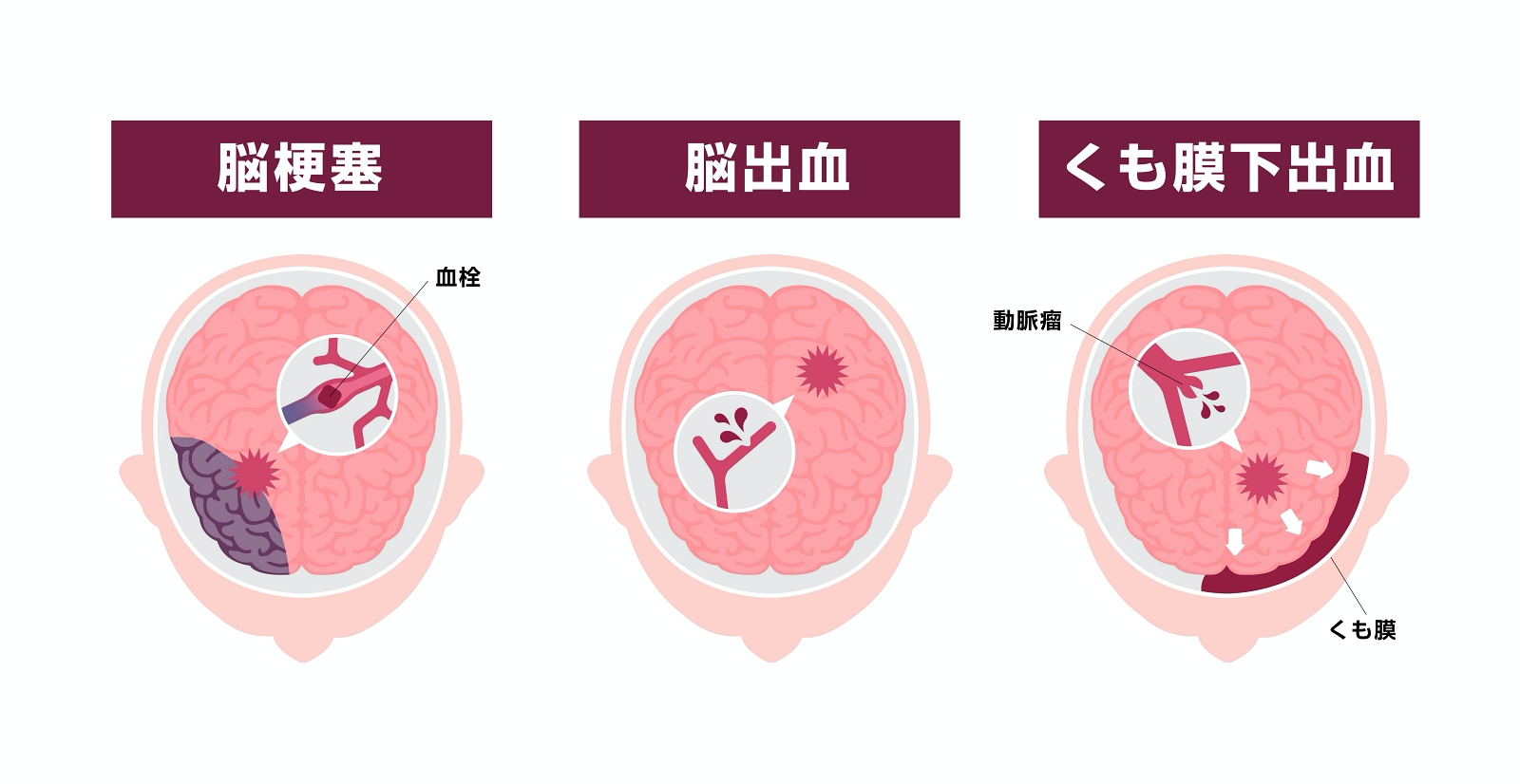 短い答え: 脳動脈瘤があれば命を落とすことはありますか?