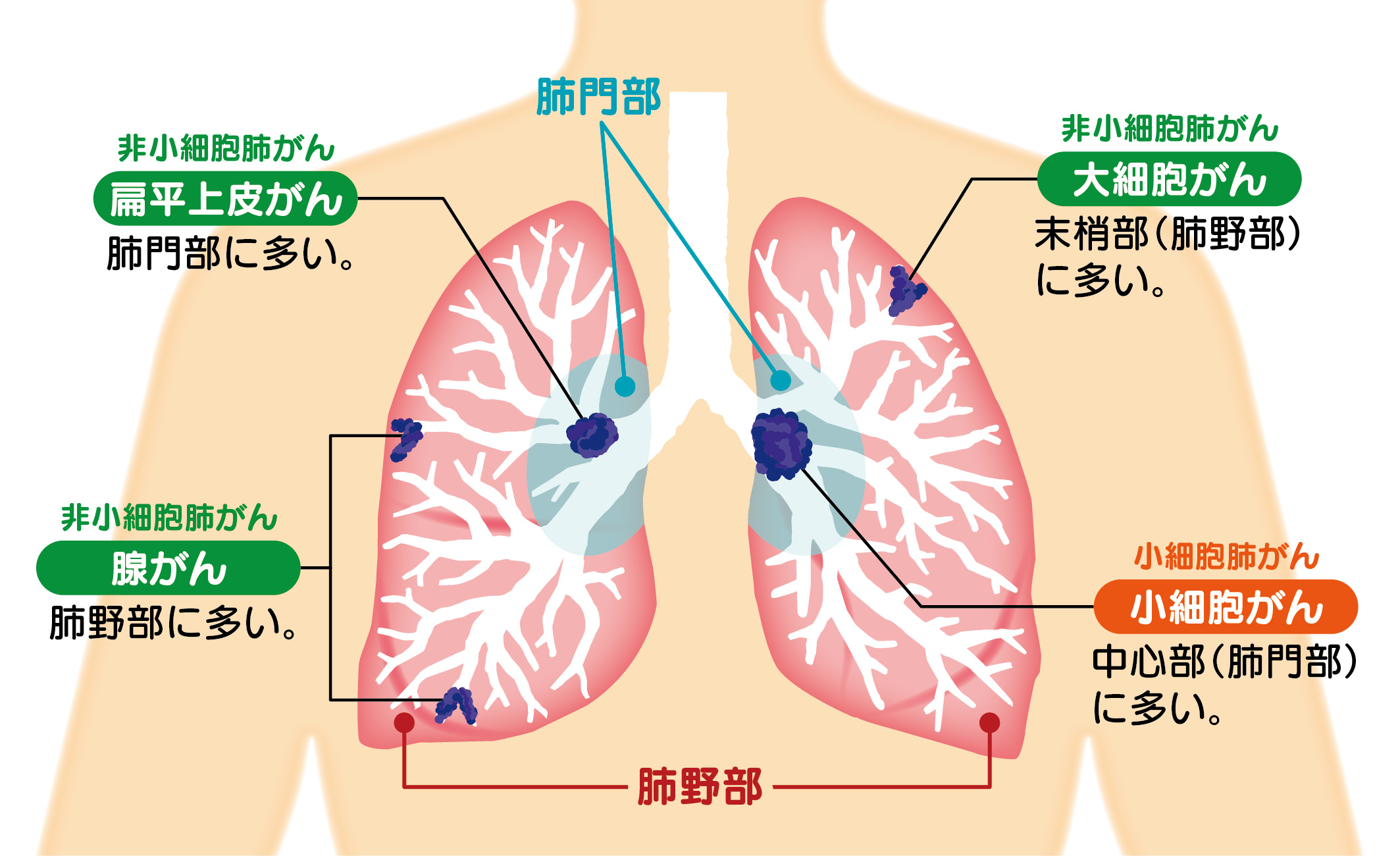 肺炎 の 跡 肺がん