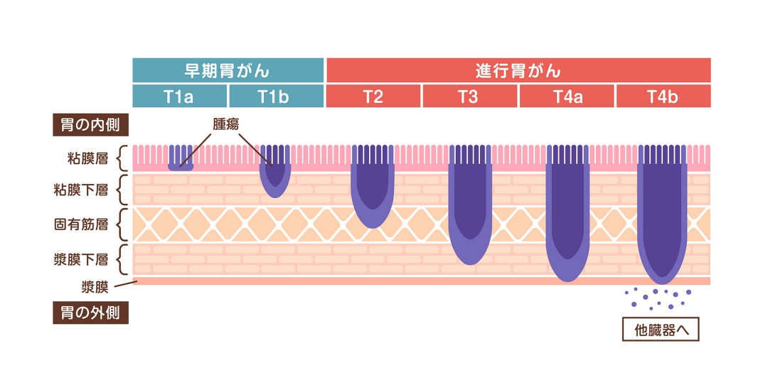 胃がんの最初の症状は何ですか?