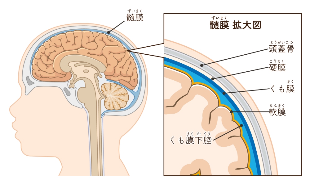 くも膜下出血とは、どんな病気?
