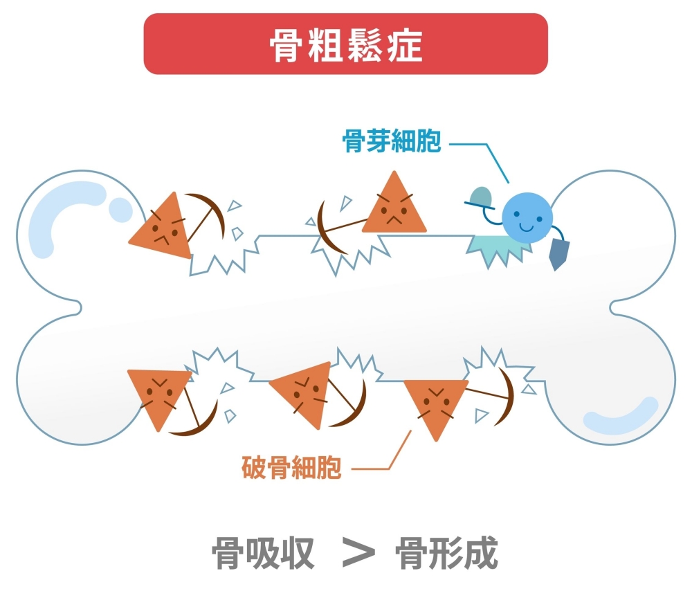 骨密度が低下するのはなぜ？