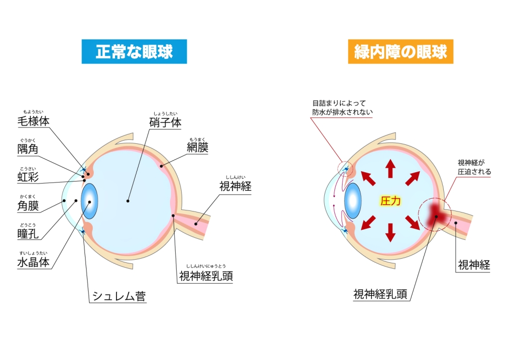 緑内障とは、どんな病気?